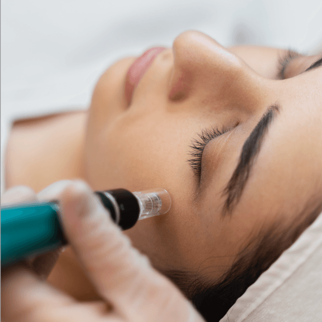 Microneedling Package of 3 at Everglow Esthetics LLC in Longmont, CO